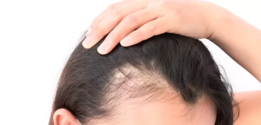 Can Dieting Cause Hair Loss?