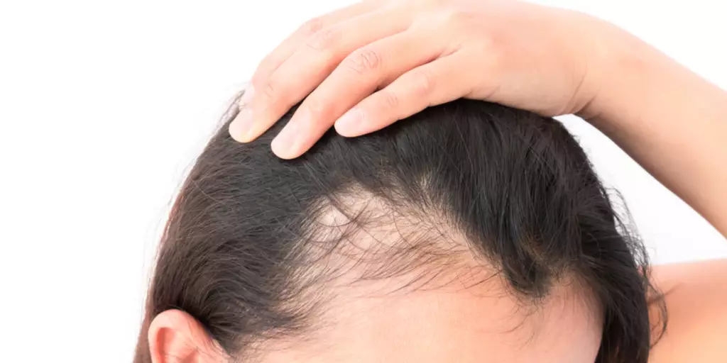 Can Dieting Cause Hair Loss?